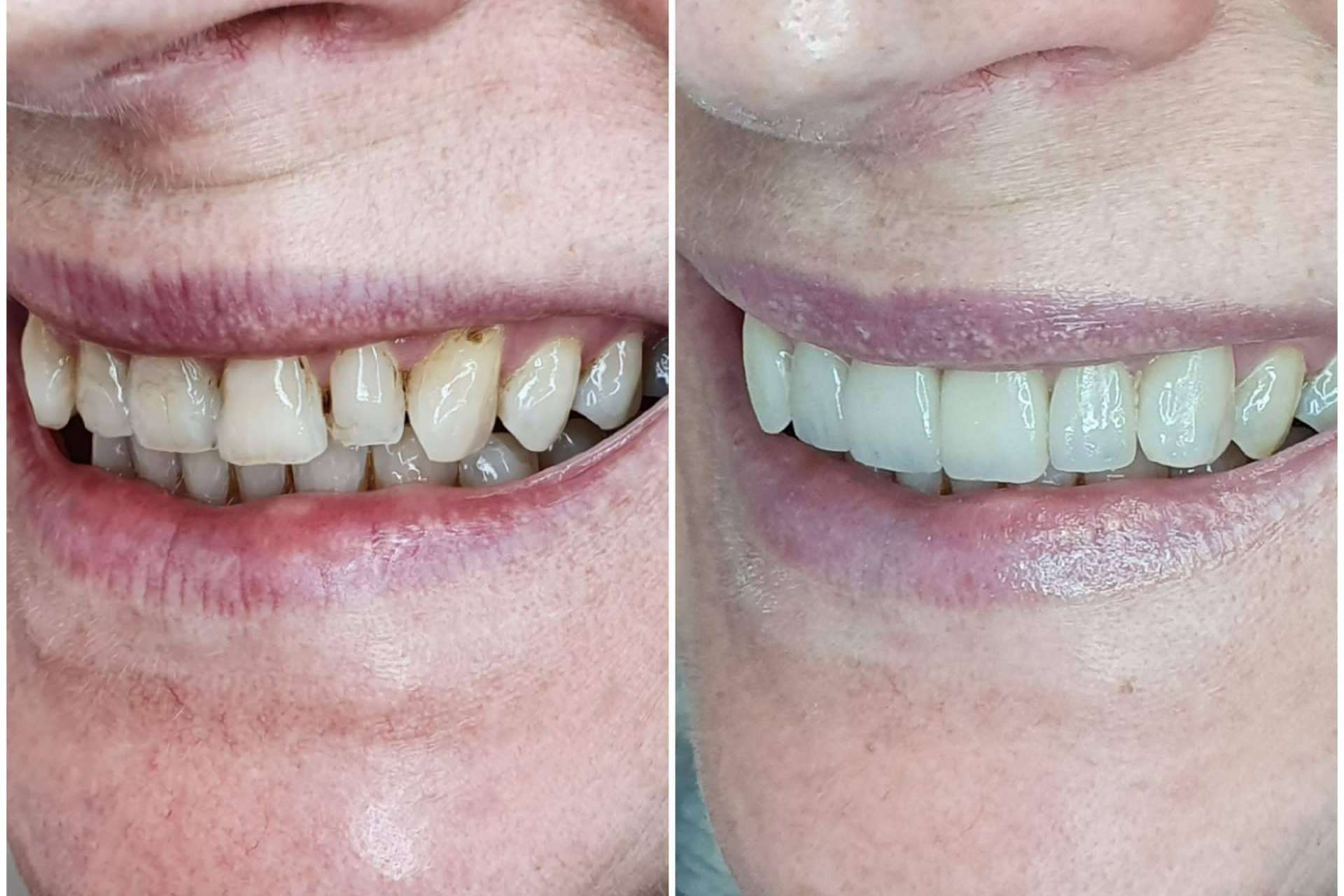 Conseguir una adecuada estética dental en 2 visitas, con Dentinova
