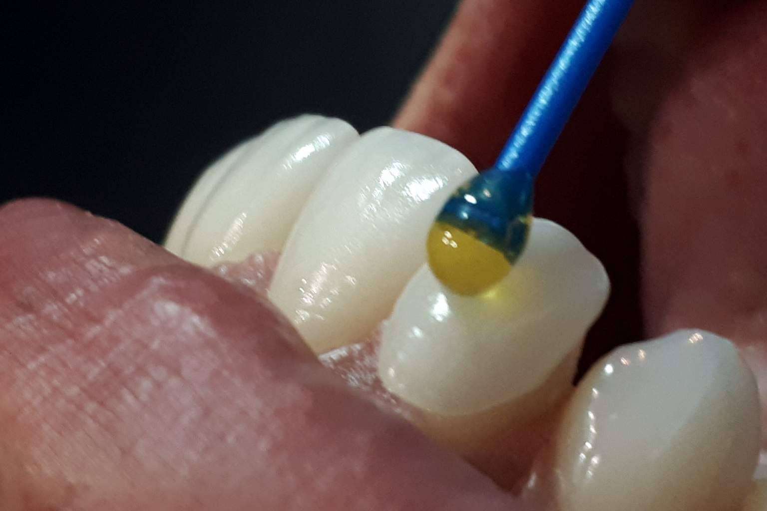 Conseguir una sonrisa Hollywood de la mano de Dentinova