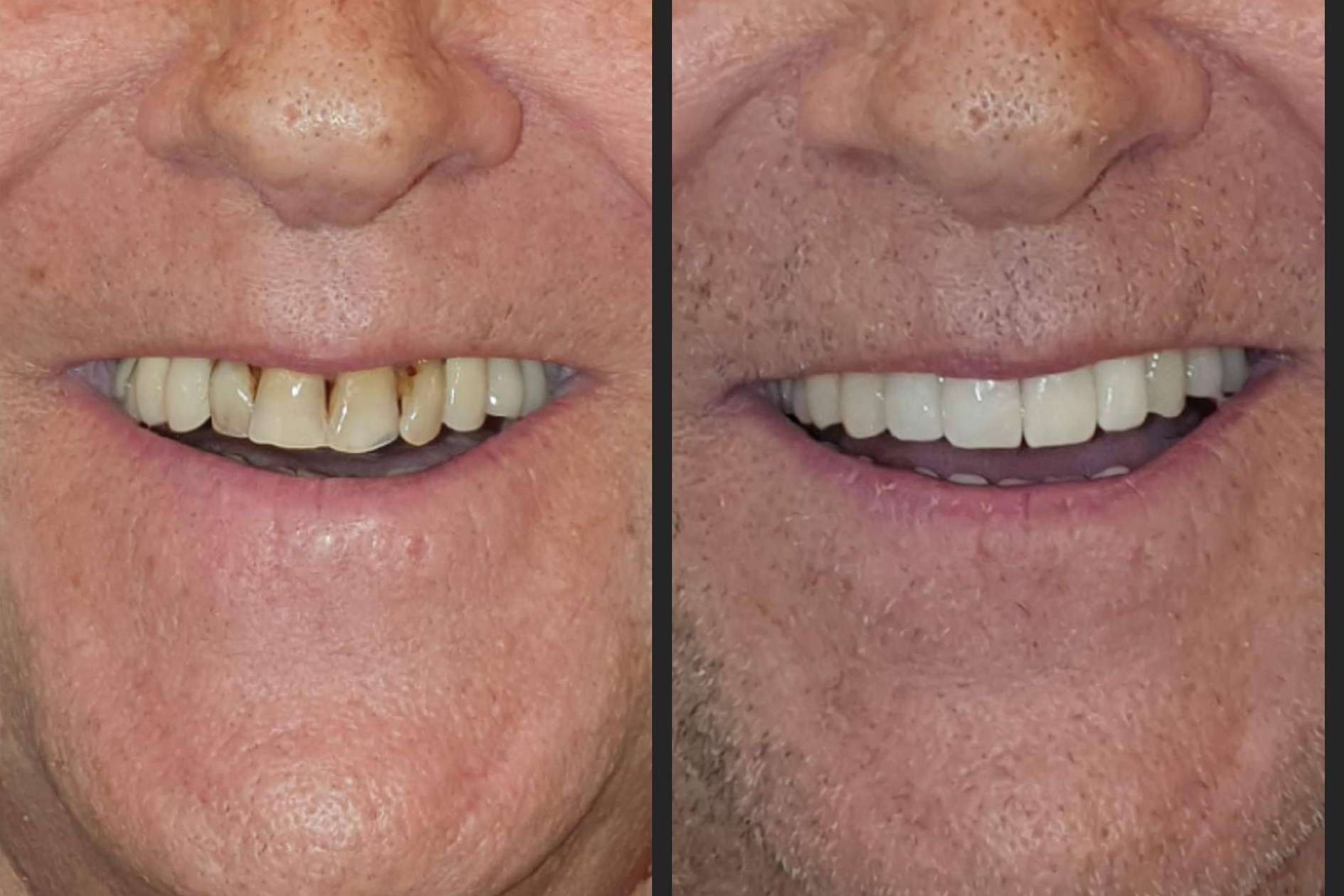 Tratamiento de alineación dentaria sin ortodoncia, por Dentinova