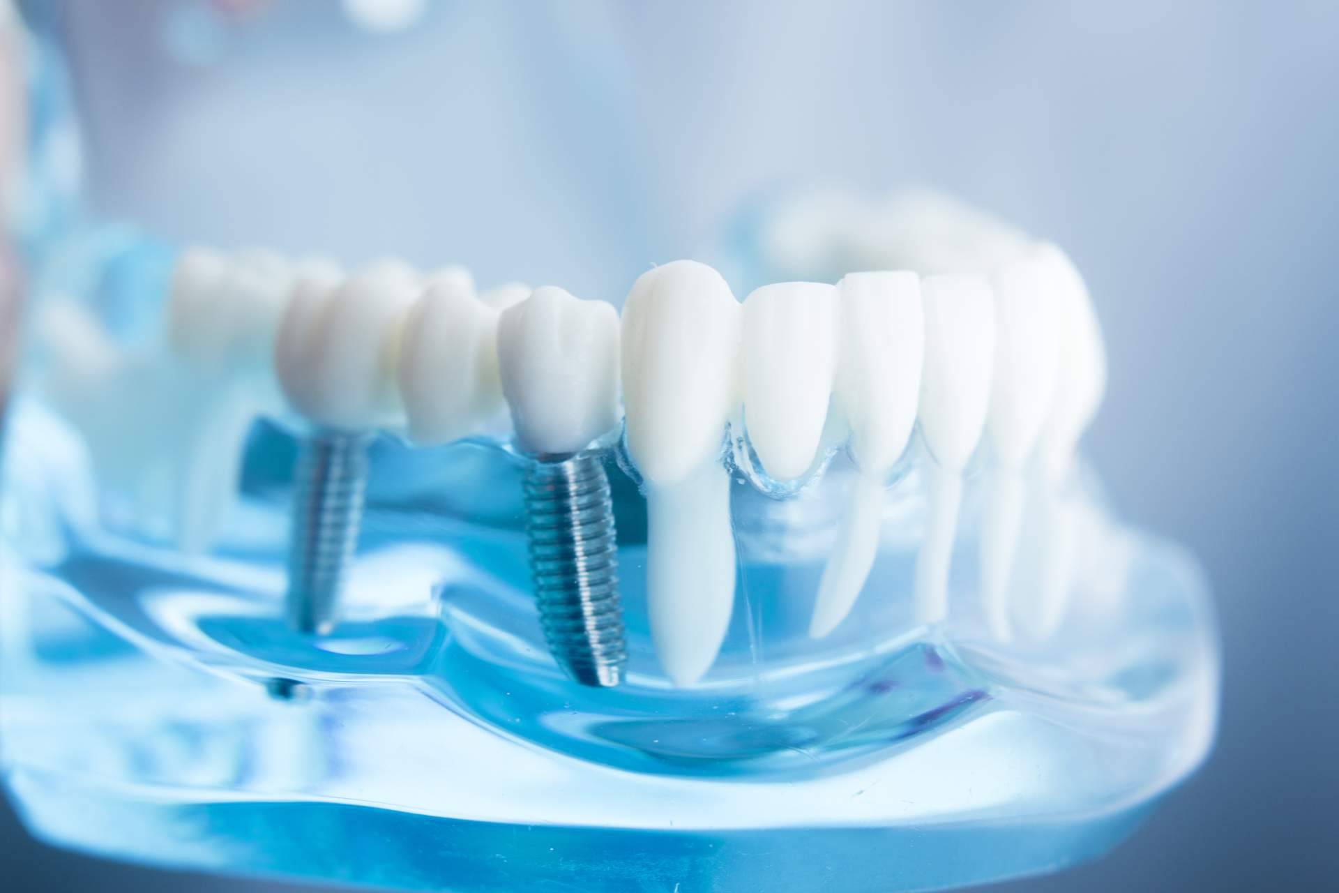 Las consecuencias de la pérdida de un diente, por Dentinova