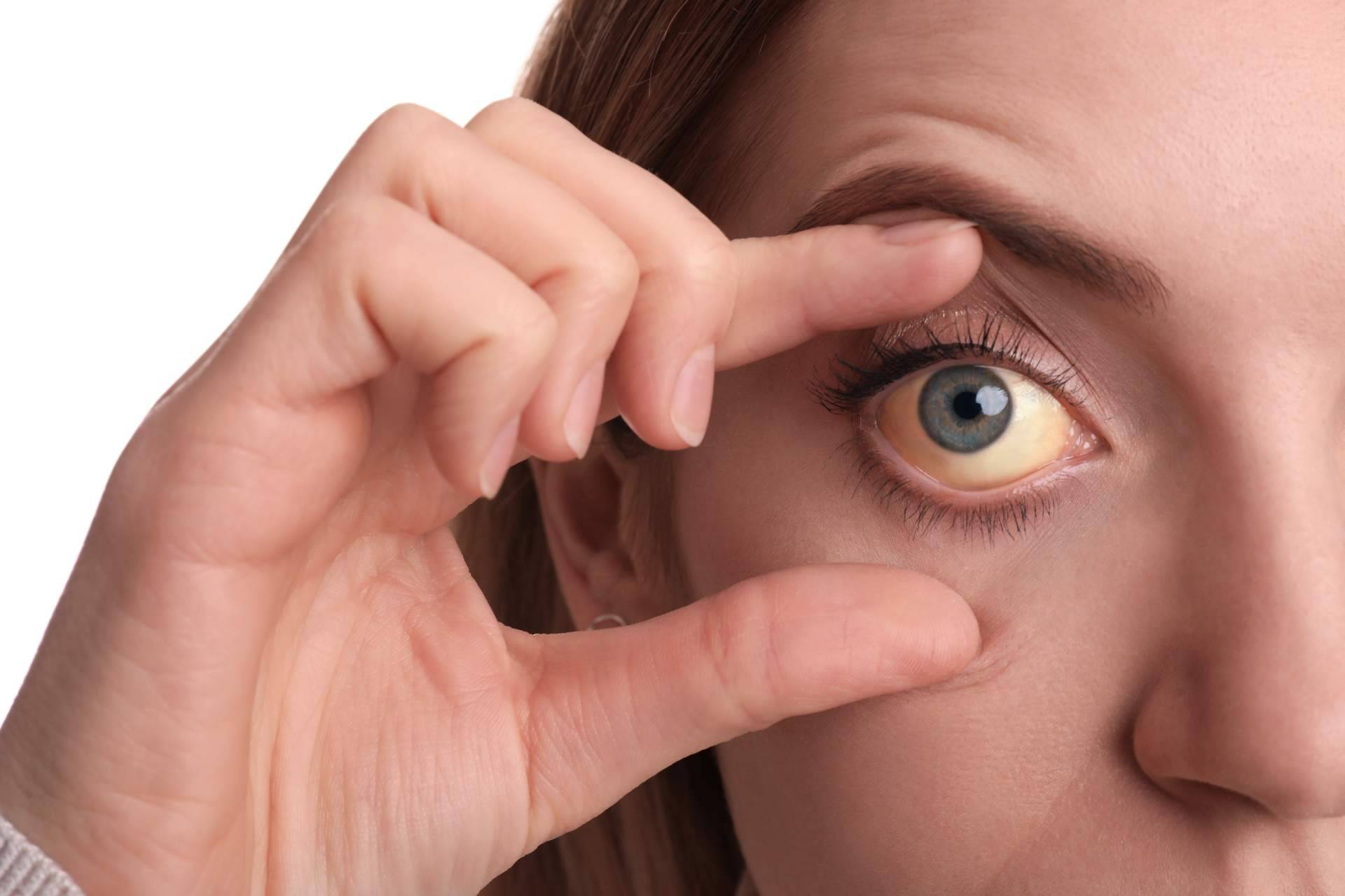 ¿A qué se deben los ojos amarillos y dónde tratarlos?, el Instituto Oftalmológico Dexeus lo explica