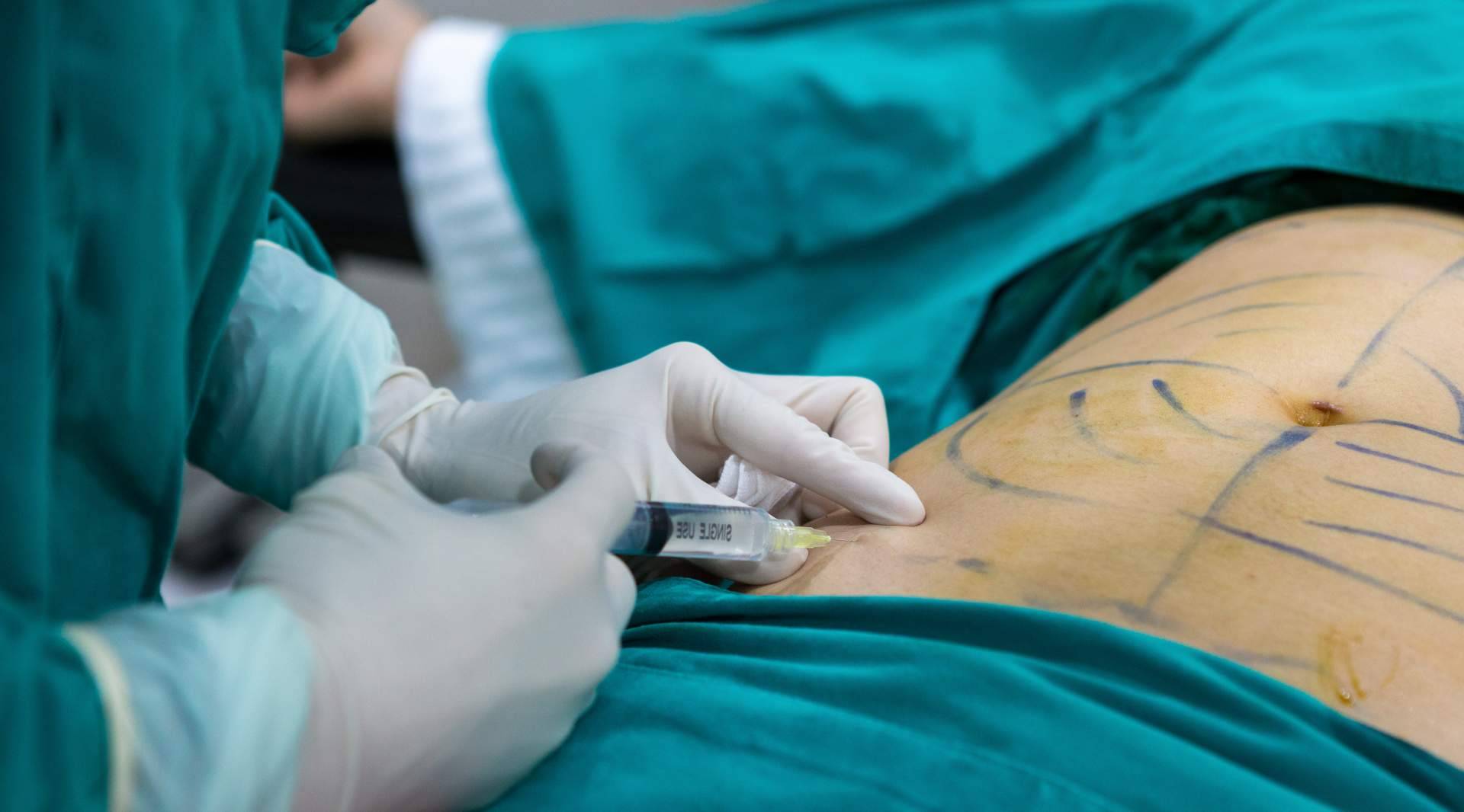 Los beneficios de la lipoescultura, por A2Clínic