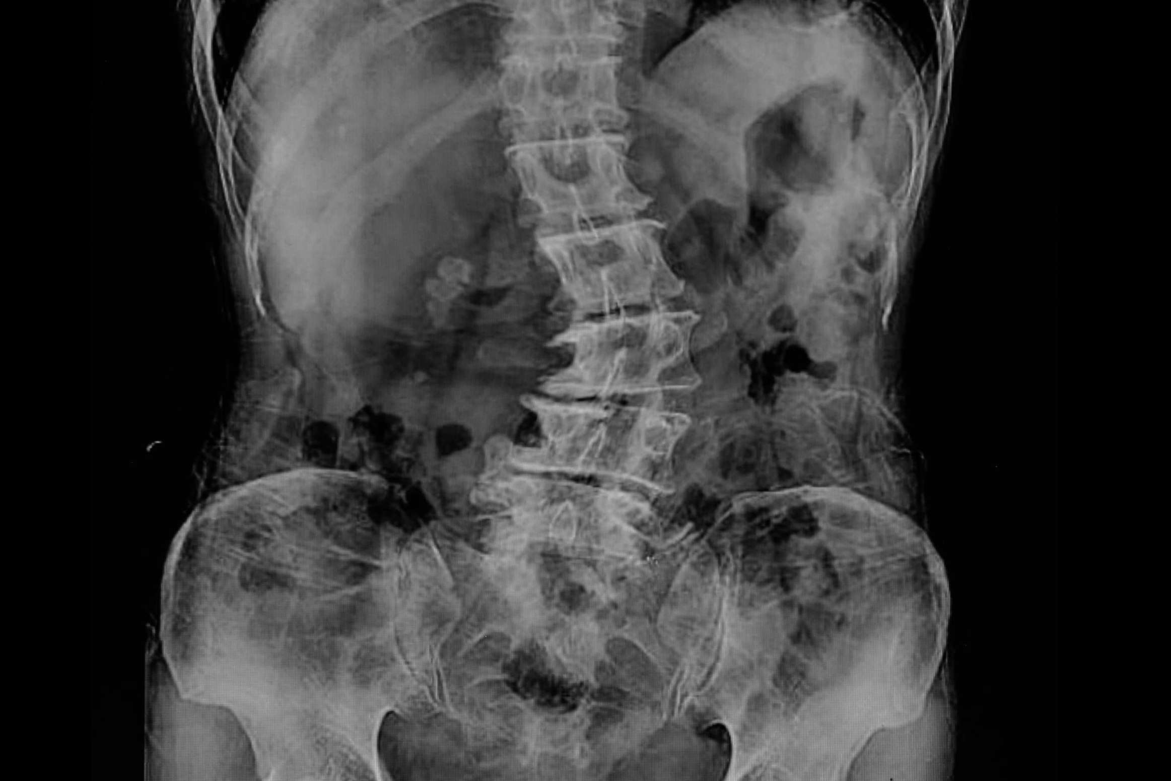 Las principales causas y tratamientos de la escoliosis lumbar