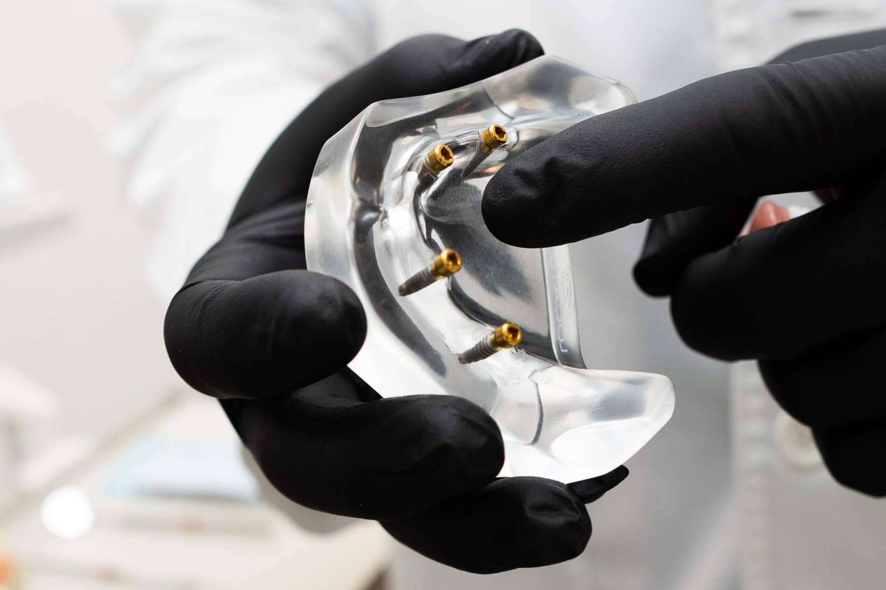 Clínica Calvo de Mora acerca de los implantes dentales que lleva a cabo