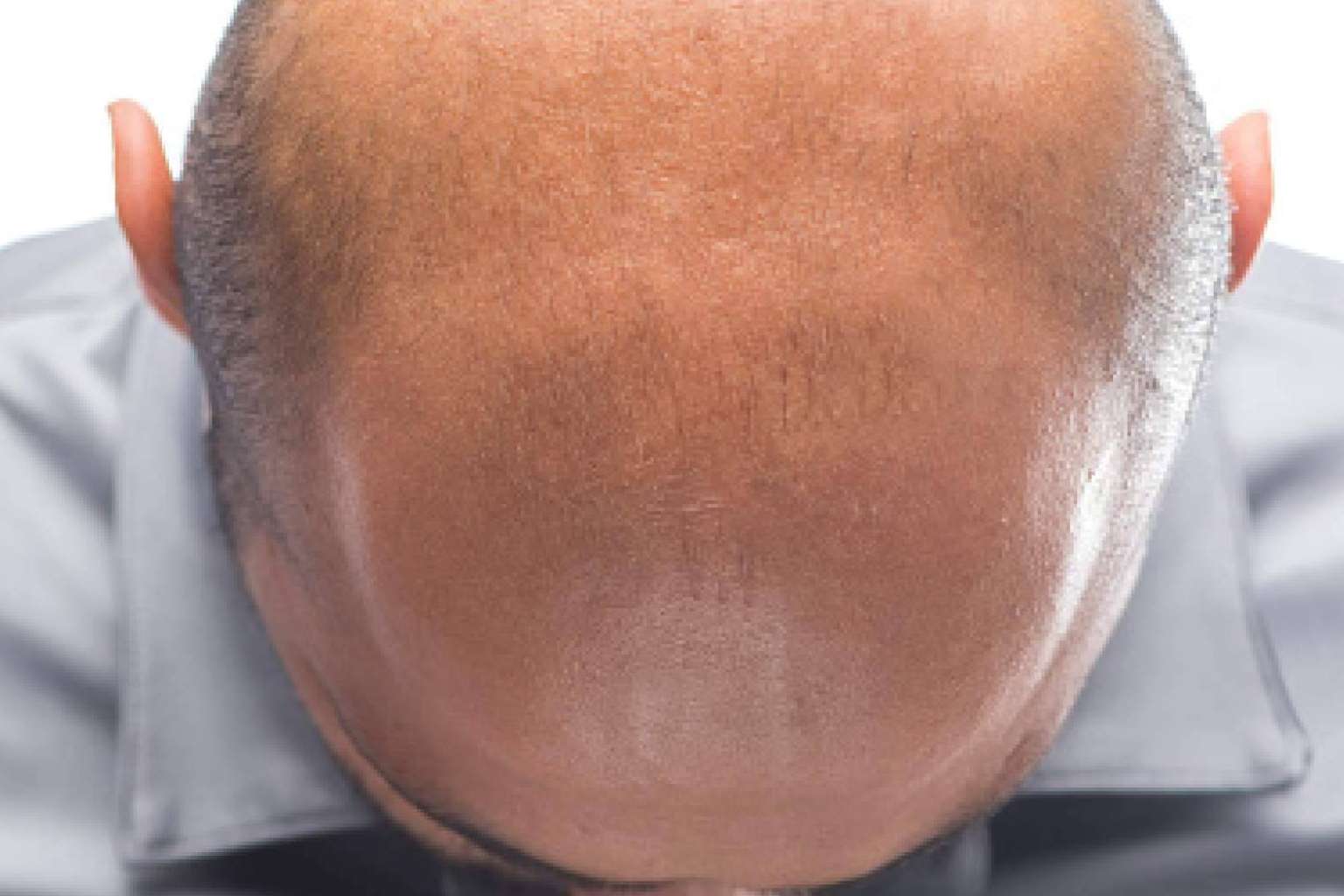 Las ventajas de la micropigmentación capilar, por Dermopigmentación Clínica