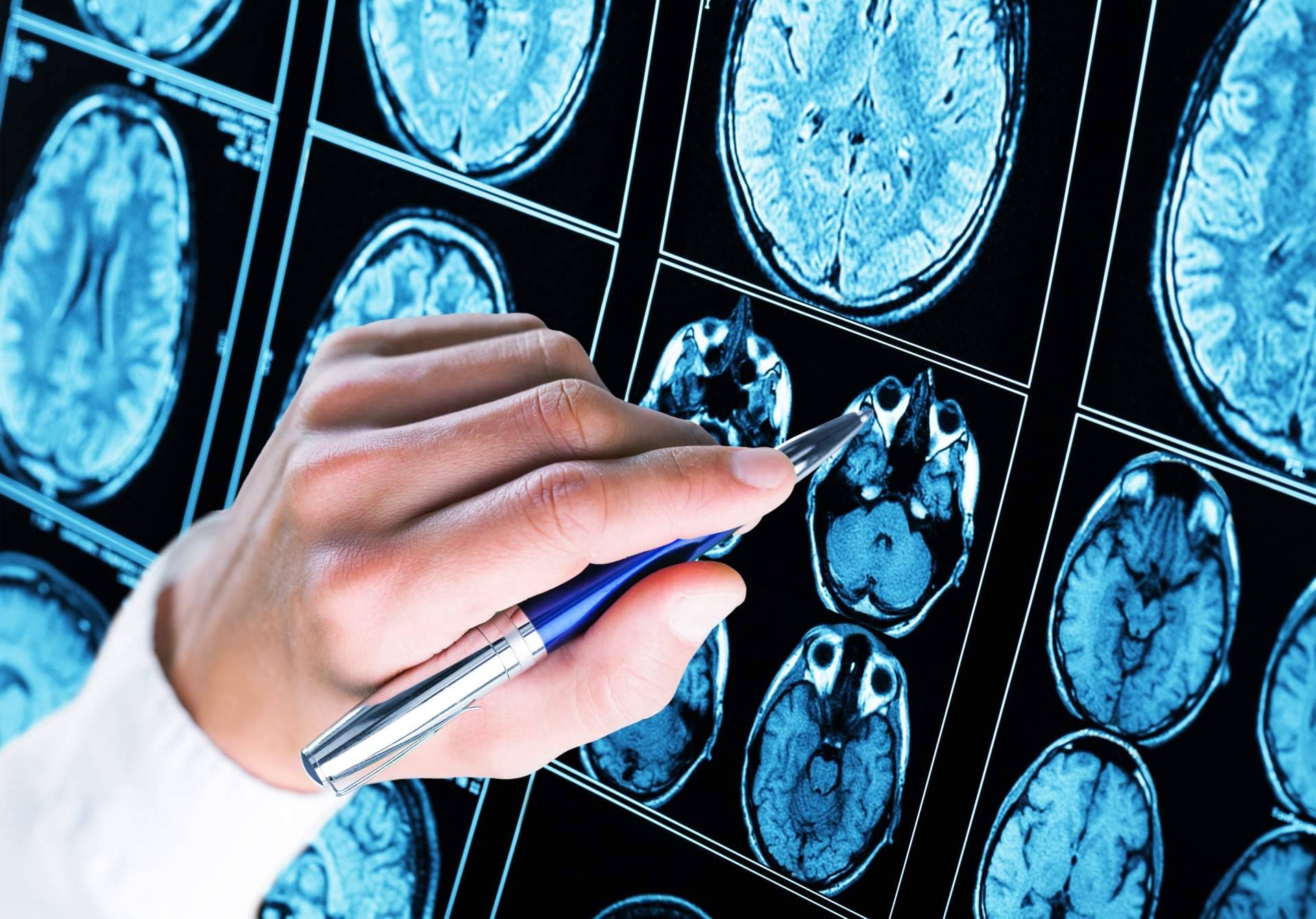 La cura para la enfermedad de Alzheimer se hace esperar, aunque se avanza
