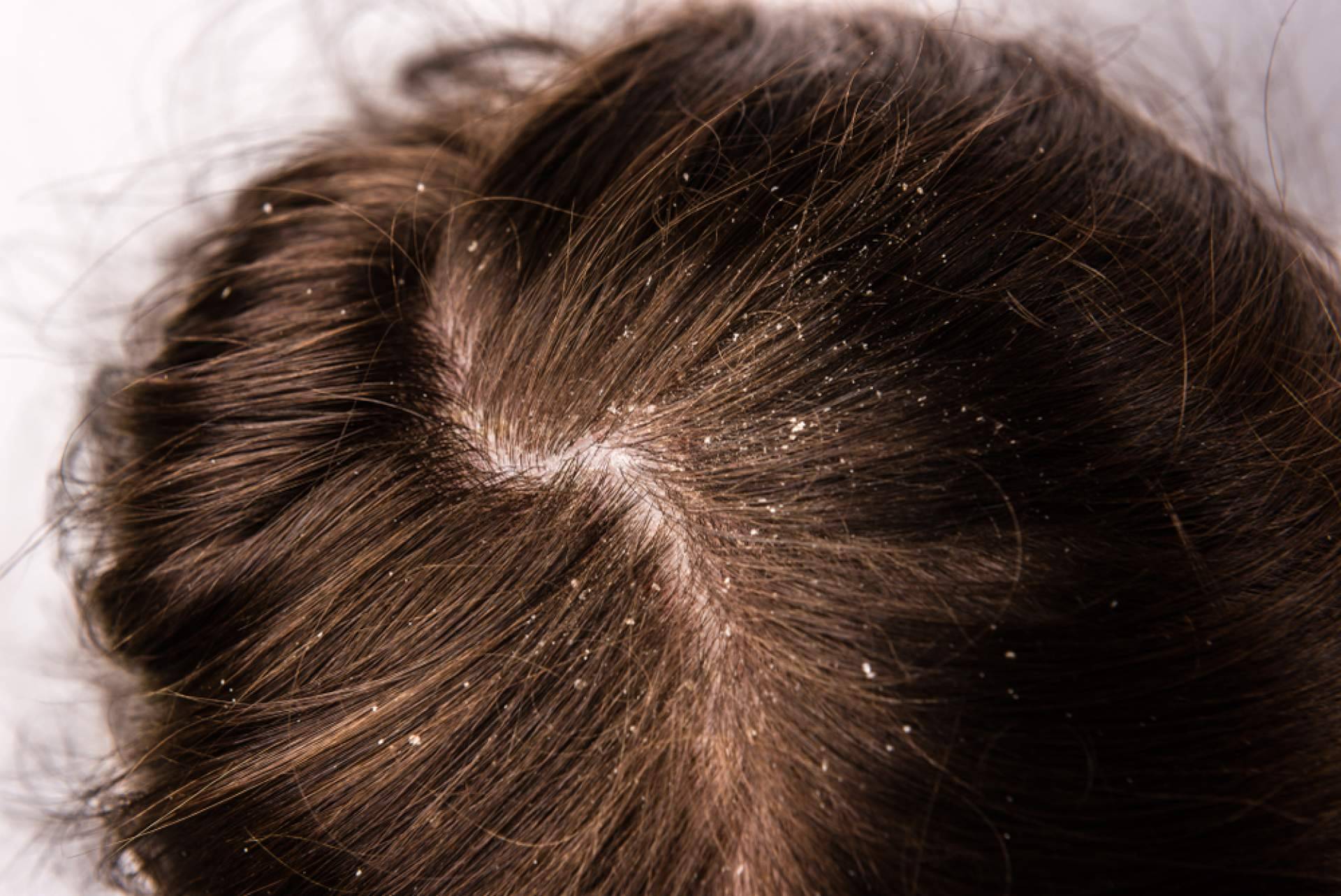 ¿Cuáles son los beneficios de realizarse un peeling capilar?, con Malecare