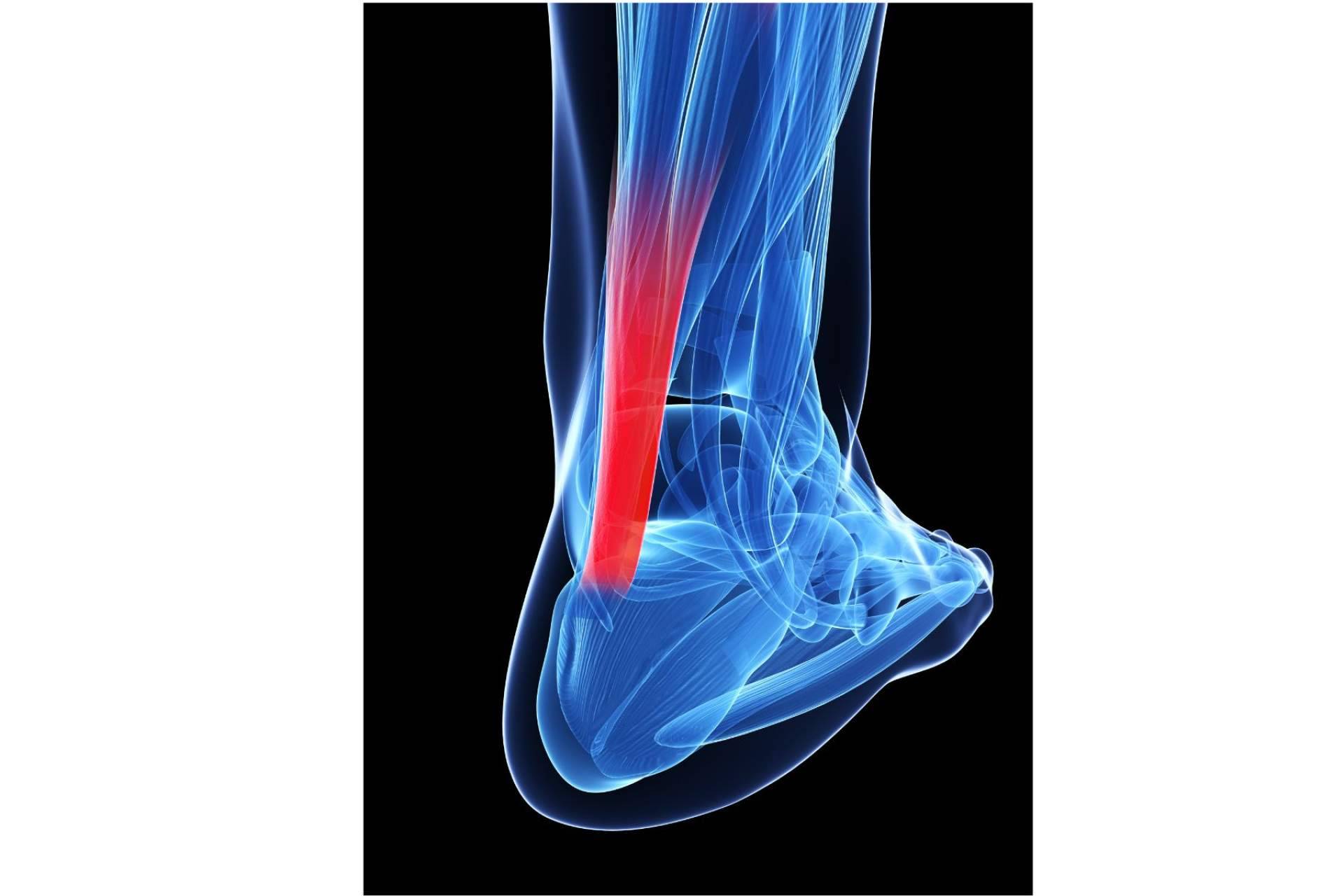 ¿En qué consiste y cómo mejorar la tendinitis con entrenamiento de fuerza?