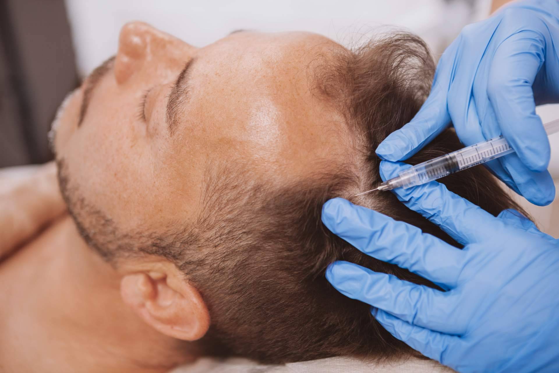 Alluring Clinic ofrece un tratamiento de la alopecia androgenética con exosomas