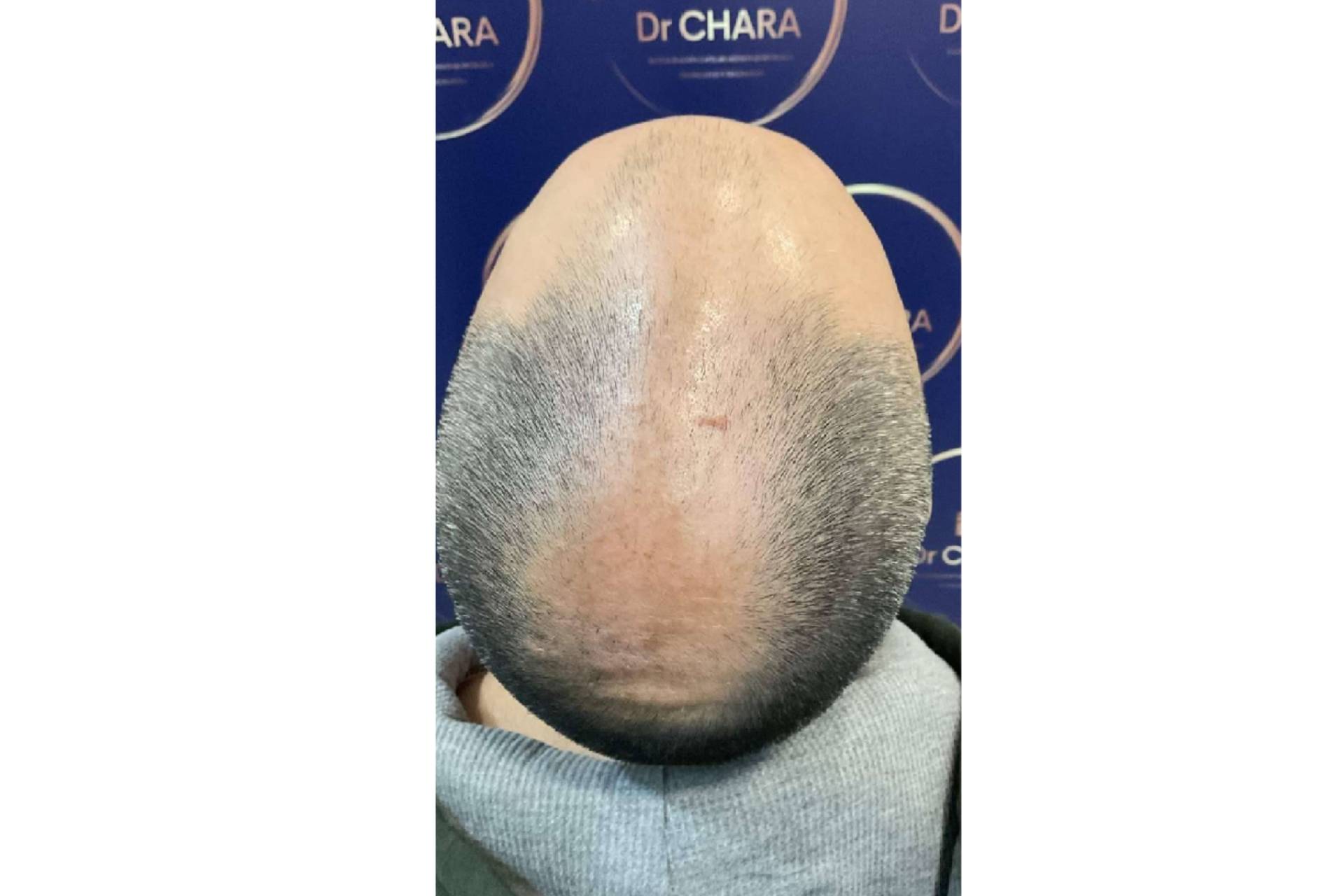 La técnica FUE y el injerto capilar en Barcelona, procedimiento que el Dr. Chara realiza con punchs de 0,7mm