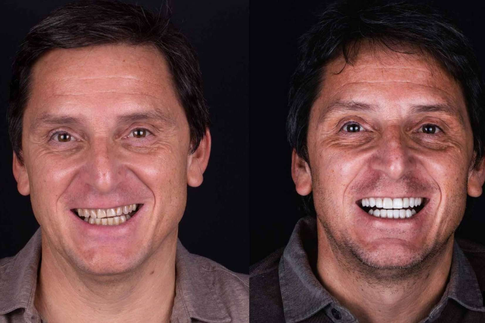 Carillas estéticas, revolución en el cuidado dental para conseguir una sonrisa estilo Hollywood