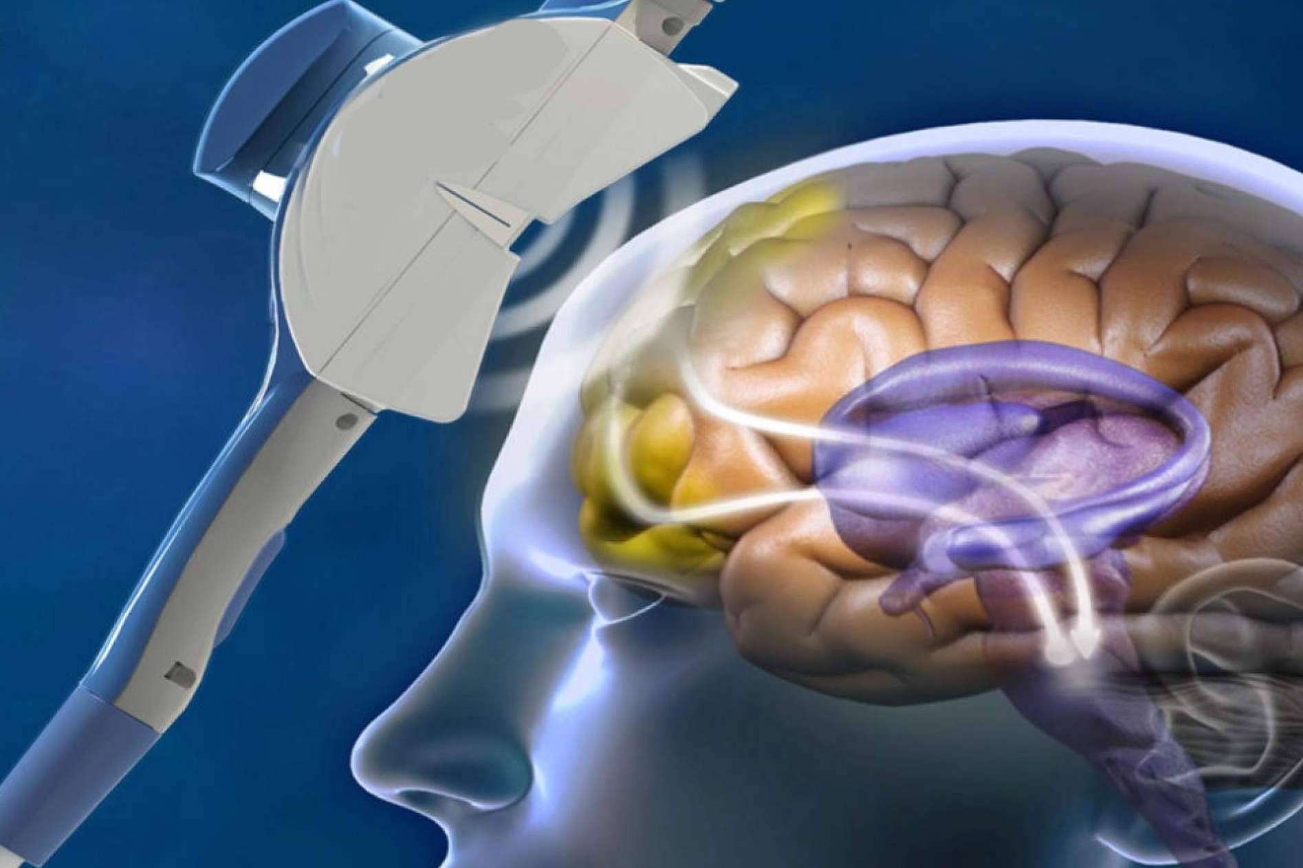Estimulación magnética transcraneal