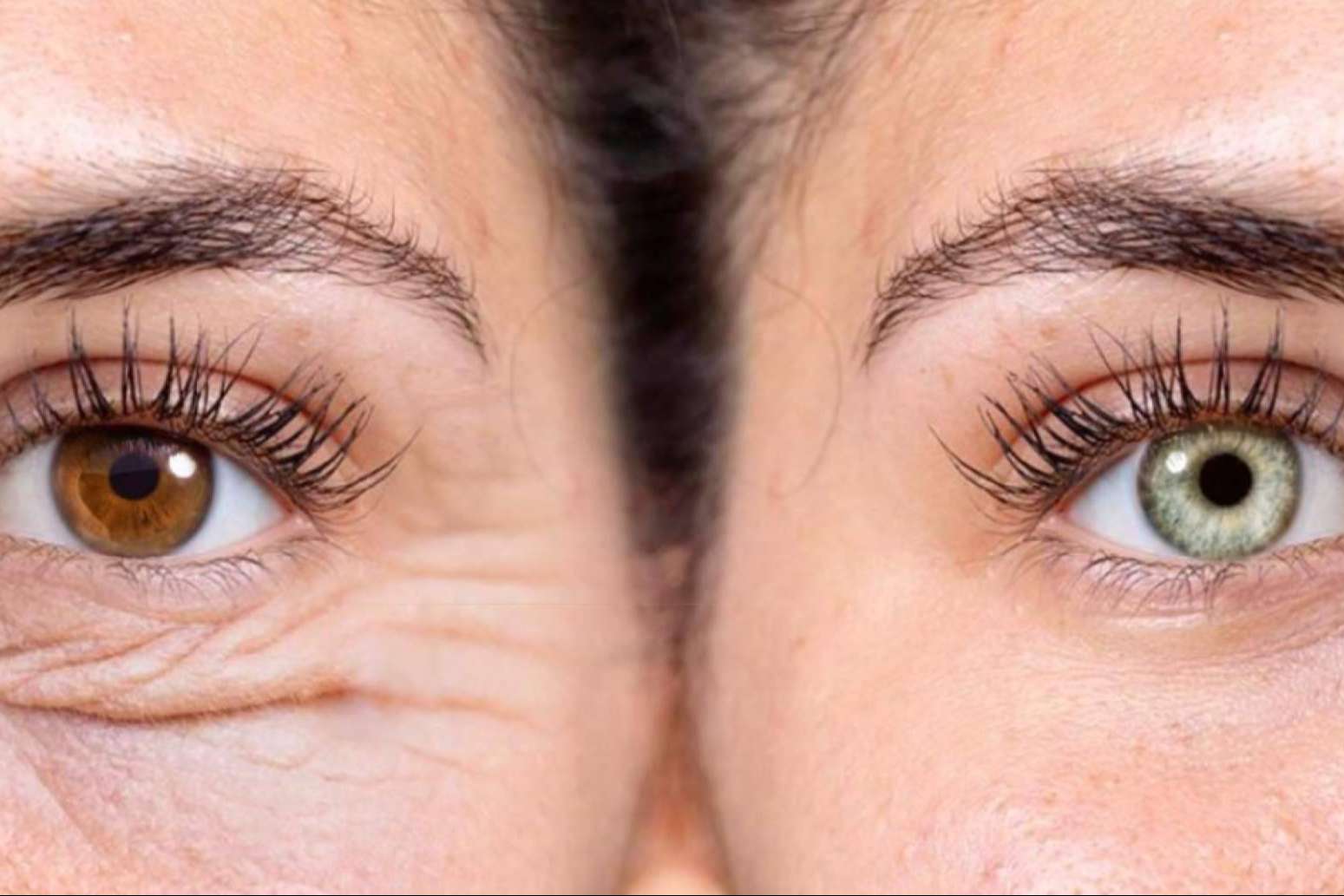 Renovar la mirada con los tratamientos láser de Clínica Eyecos