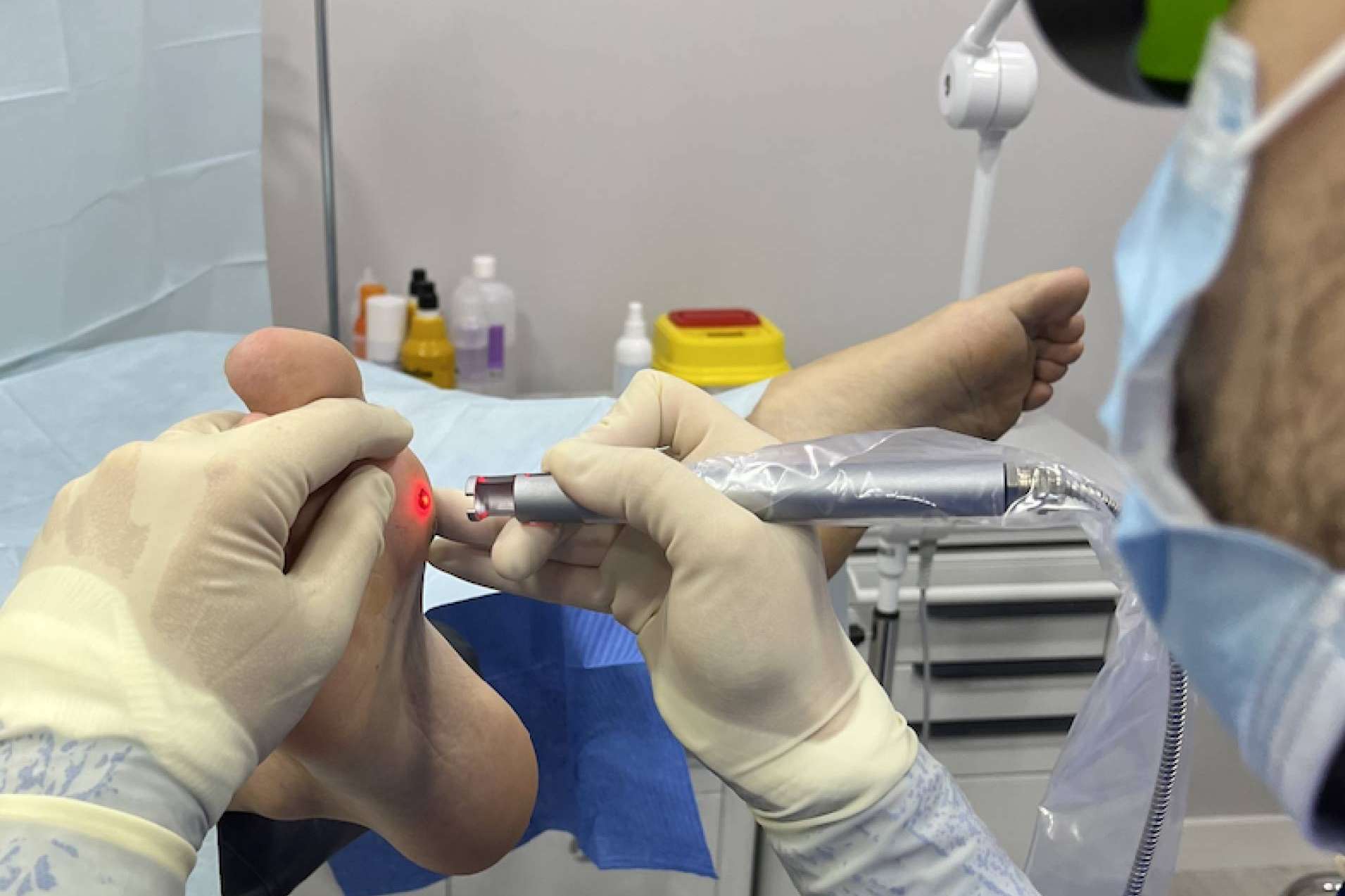 Innovador tratamiento láser para cirugías de uñas y papilomas en el pie, de la mano de DM Clínica