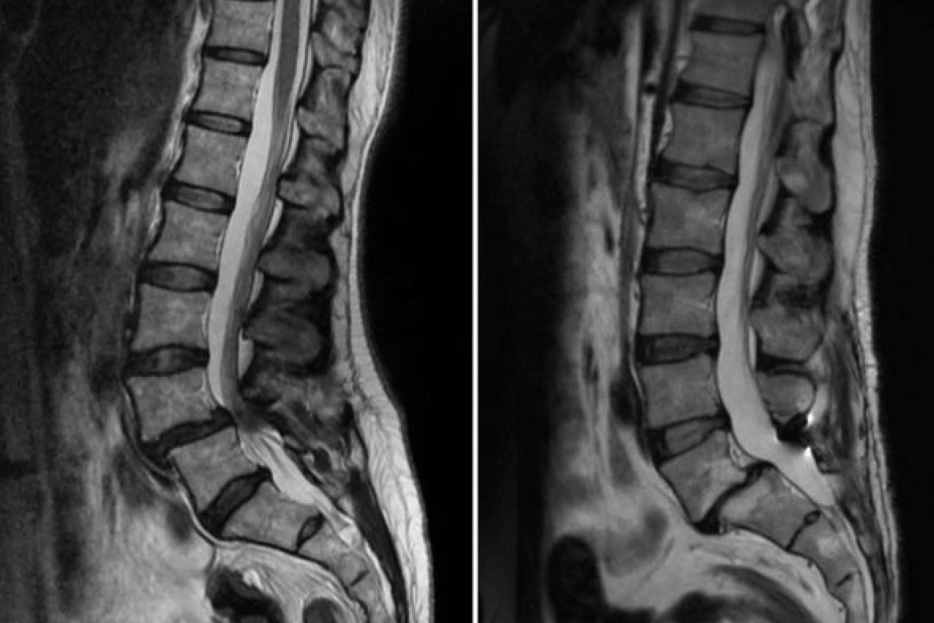 El Dr. Botella-Asunción habla sobre la Espondilolistesis Lumbar