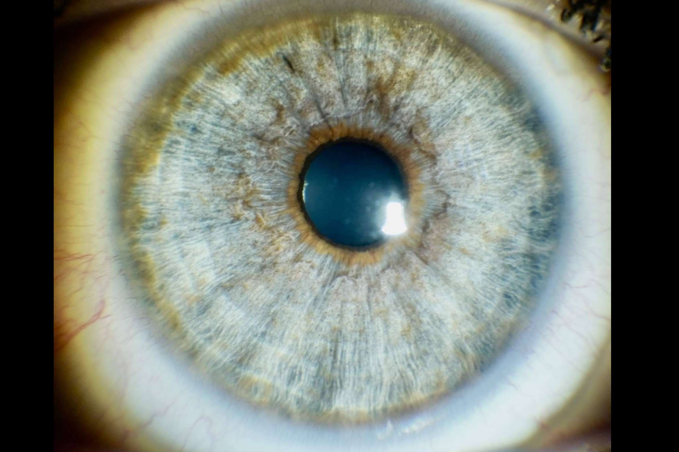 Cambio de color de ojos con láser, Eyecos aclara algunas de las dudas más comunes