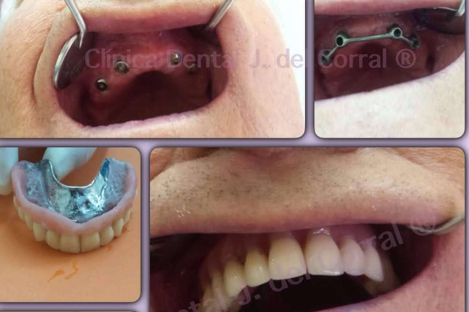 Clínica Dental Jorge del Corral, excelencia en implantología dental