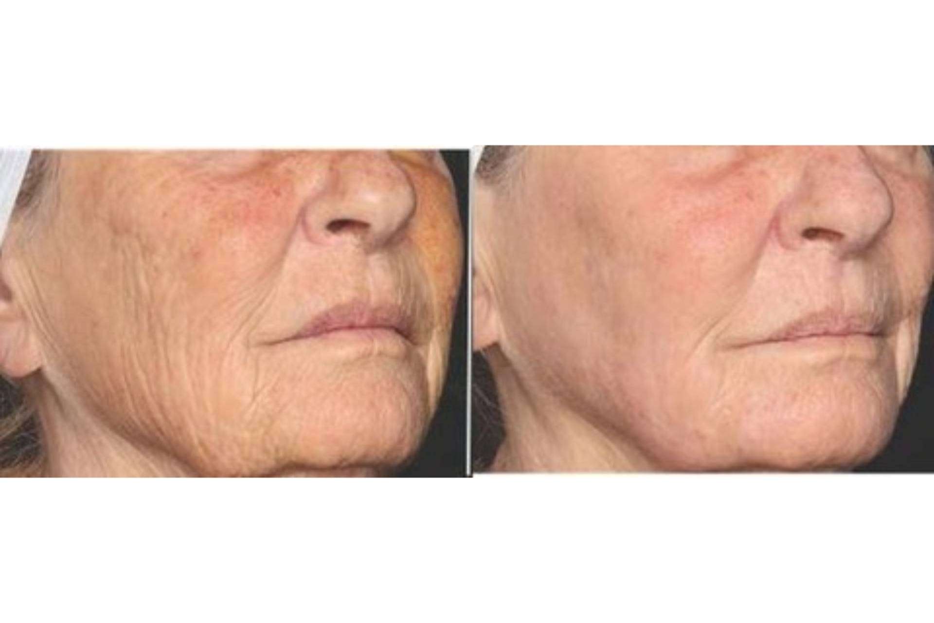 Revolución estética en Clínica Dermatológica Internacional (CDI) al incorporar el láser frío regenerativo que combate todos los signos de la edad