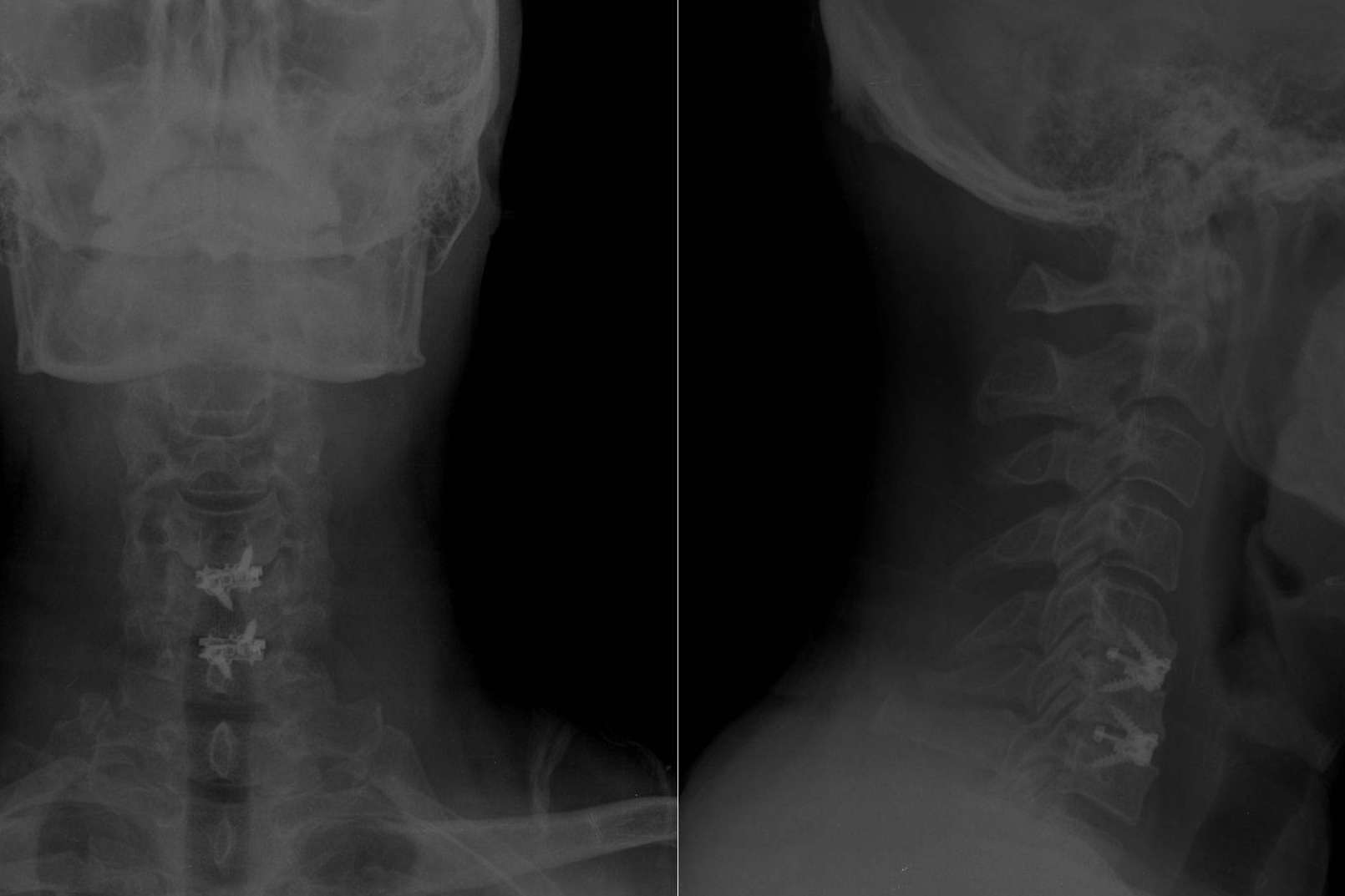 Tratamiento de la hernia discal cervical
