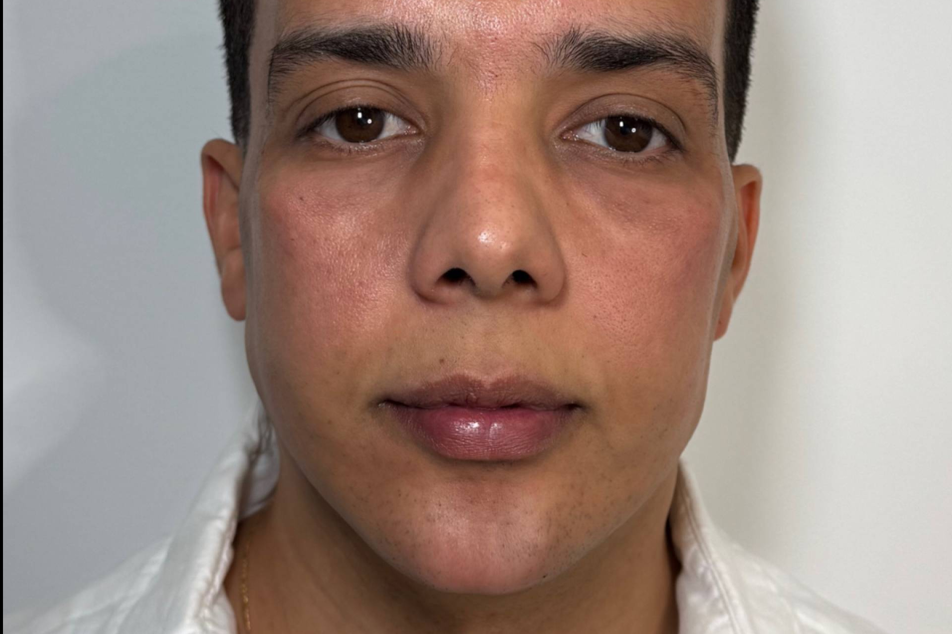 La Dra. Cecilia Arthur redefine el rostro masculino con ácido hialurónico y técnicas no invasivas