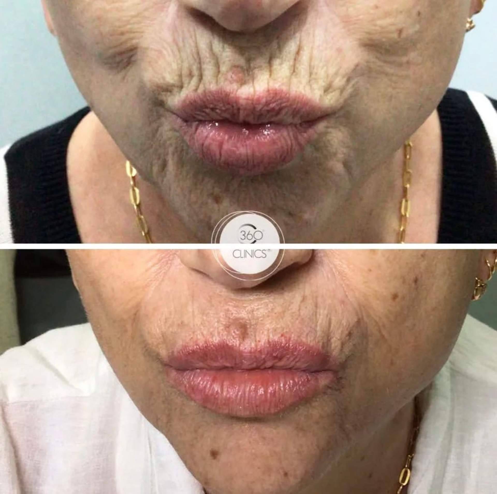 Cómo eliminar el código de barras; las arrugas del labio superior que la medicina estética corrige con ácido hialurónico