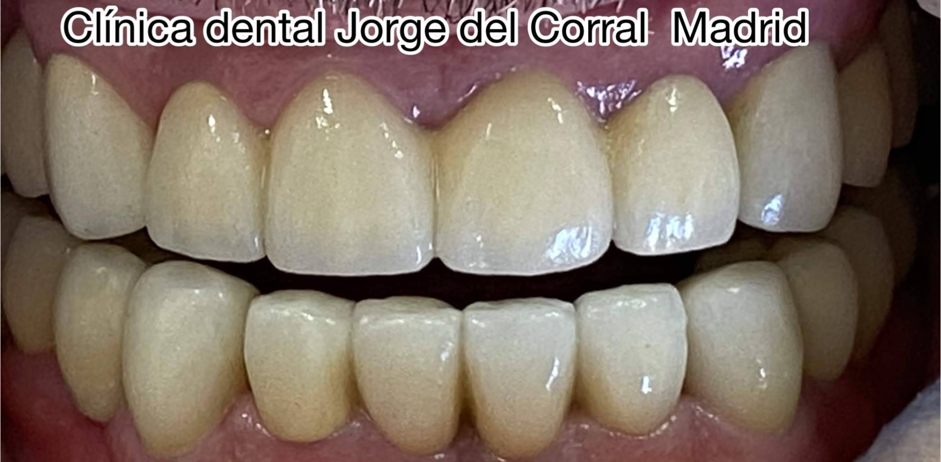 La Clínica Dental Jorge del Corral en Hortaleza, Madrid, ofrece implantes dentales con descuento y primera consulta gratuita