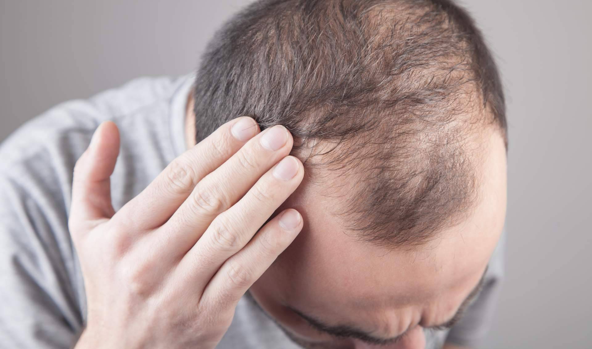 Xpecia Hombre combate la alopecia androgénica con una fórmula específica para frenar la caída del cabello