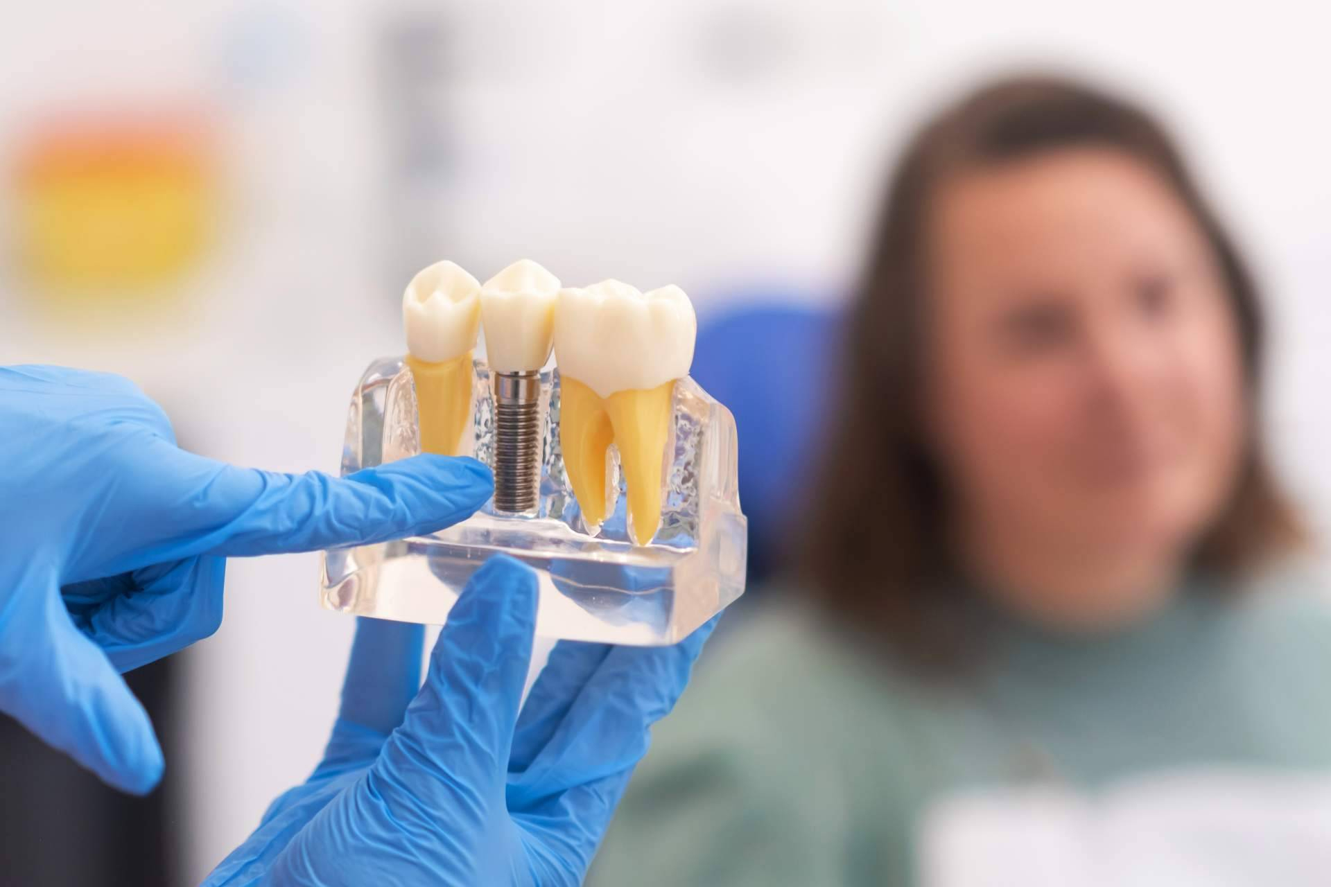 La demanda de implantes dentales crece como respuesta a la pérdida de piezas dentales