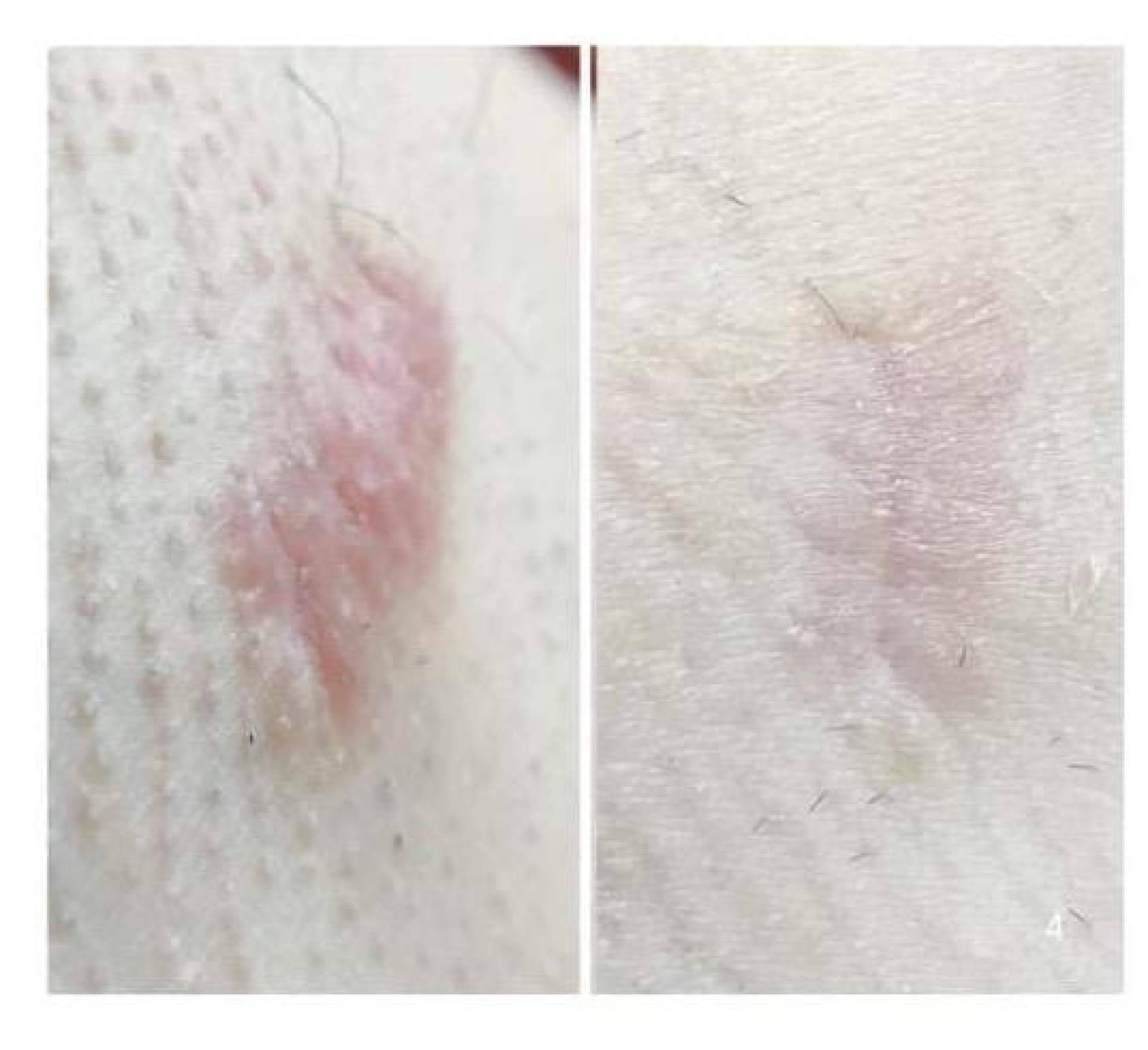 Cicatrices en Barcelona, tratamiento especializado para acné, cesáreas y quemaduras en Cossbelt by Oksana