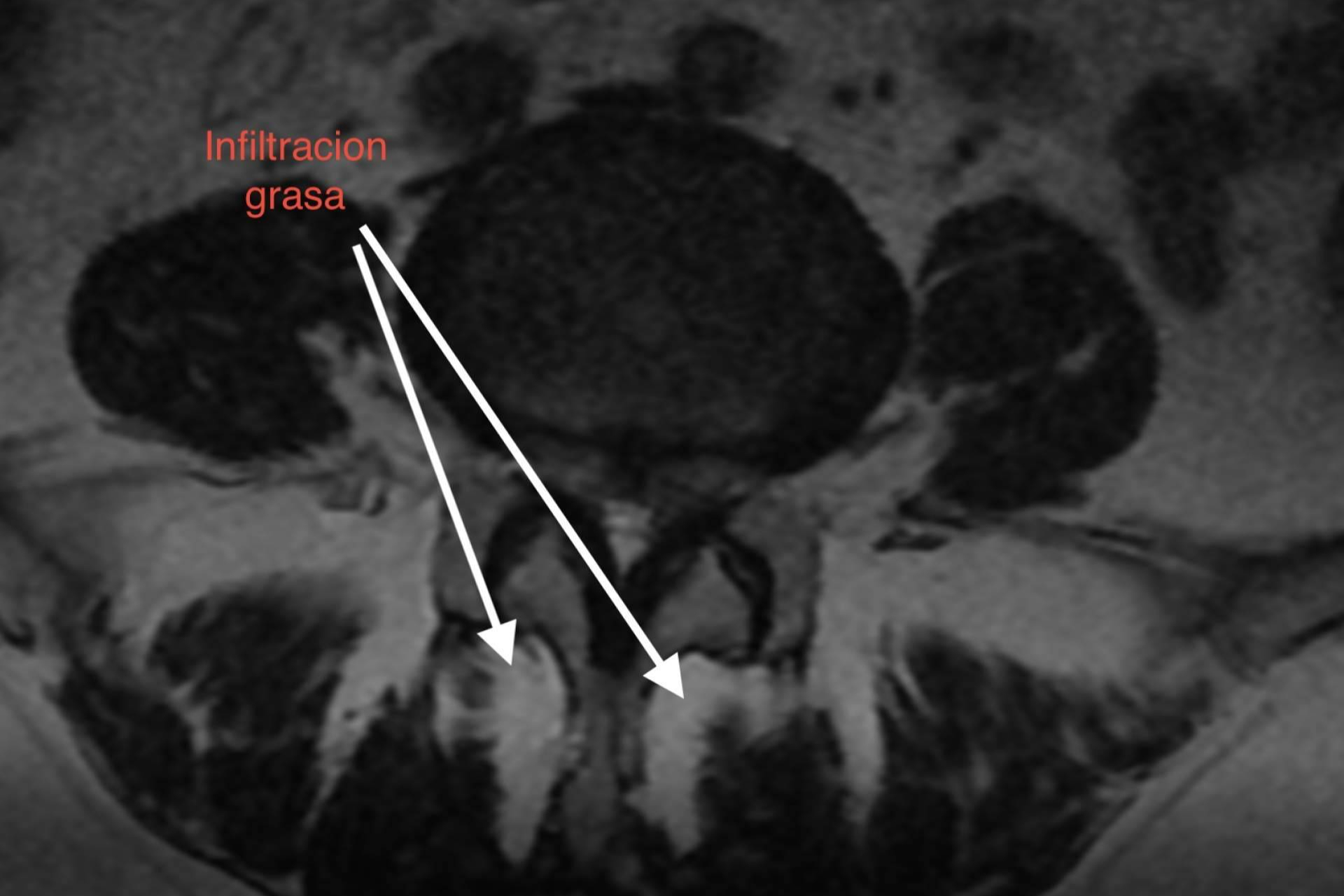 Impacto de la sarcopenia y la infiltración grasa paravertebral en la degeneración del segmento adyacente