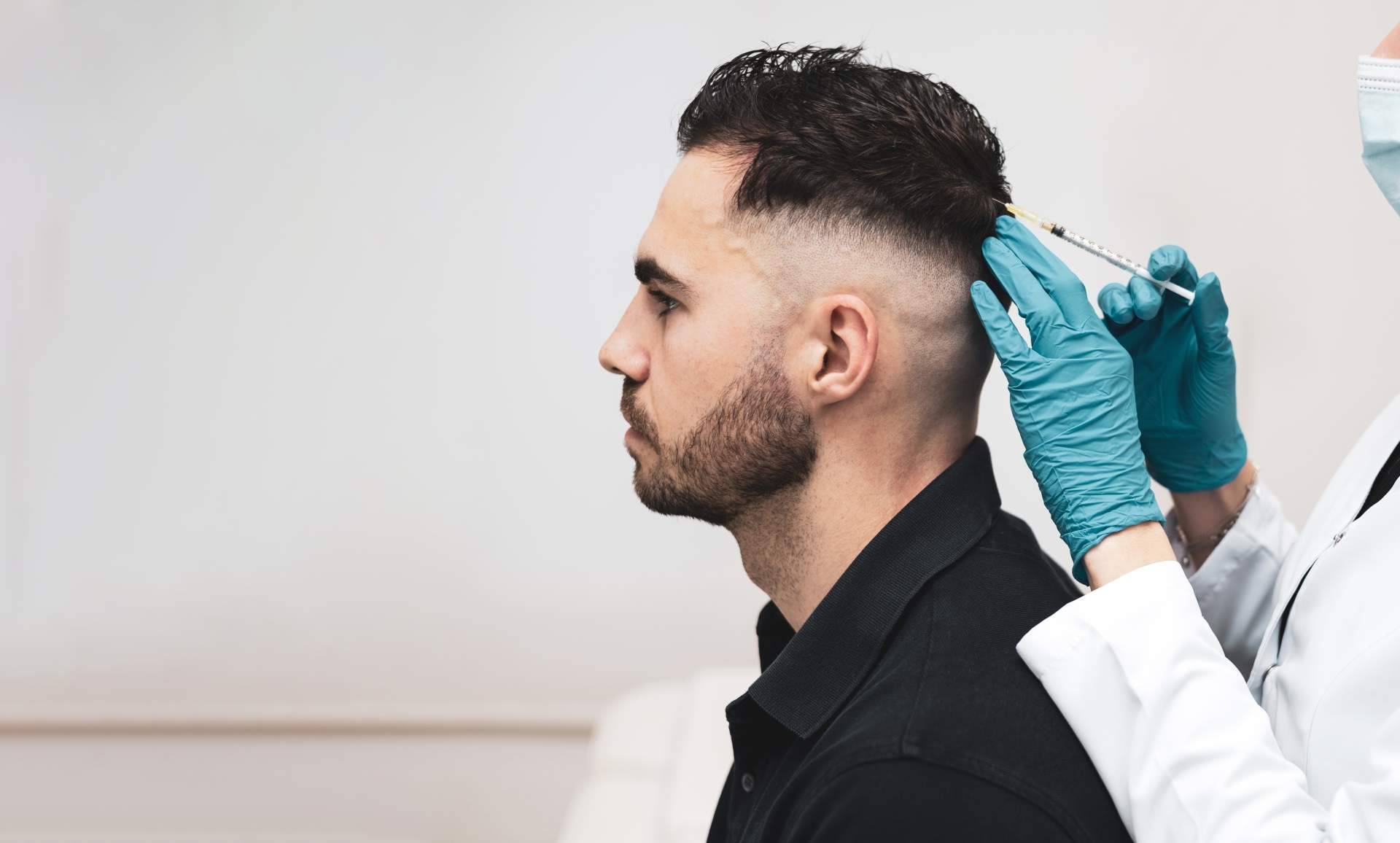 La mesoterapia capilar se abre paso como complemento al trasplante capilar en casos de pérdida de cabello