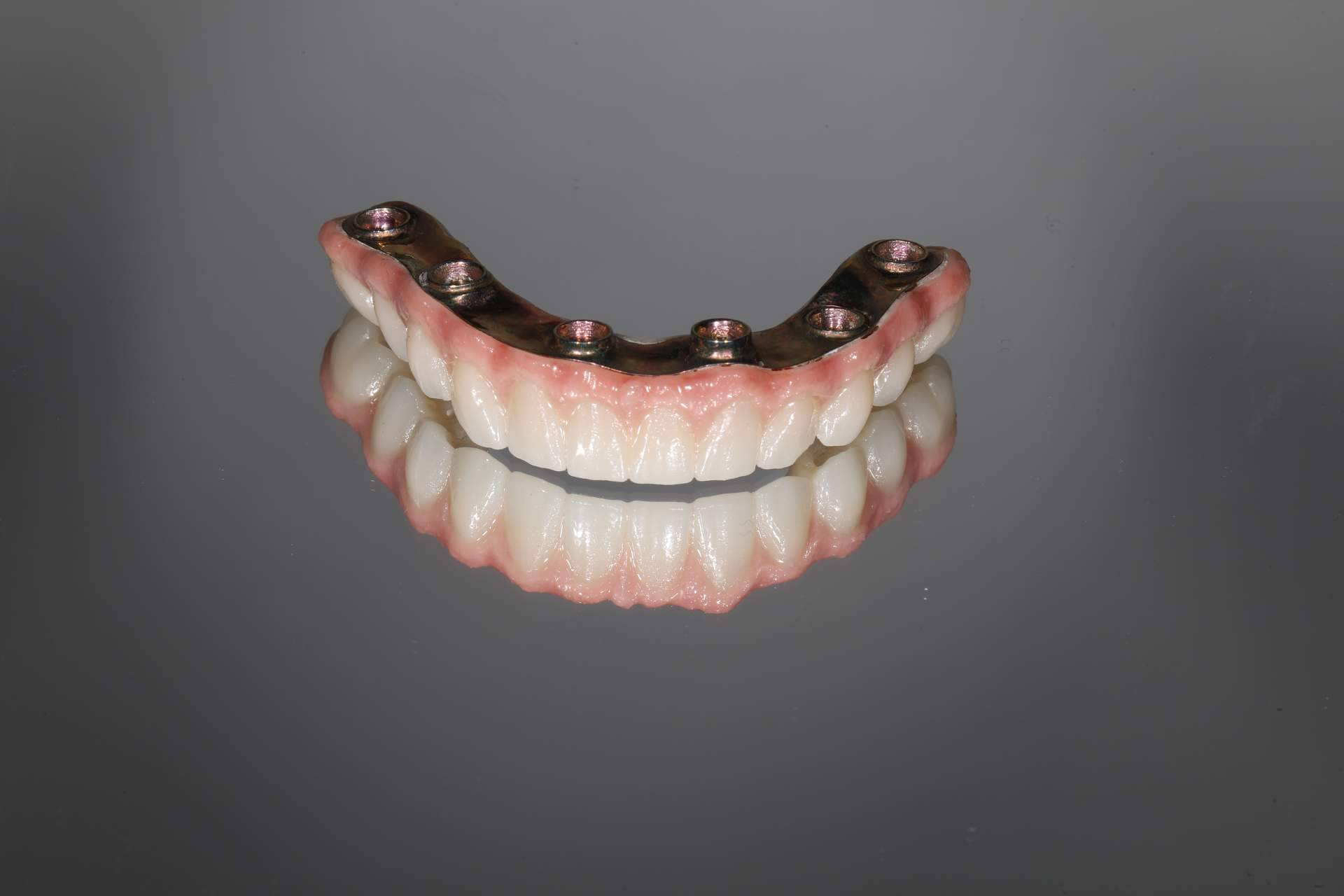 Por qué no todos los implantes dentales son iguales. Qué debería saber un paciente antes de decidir