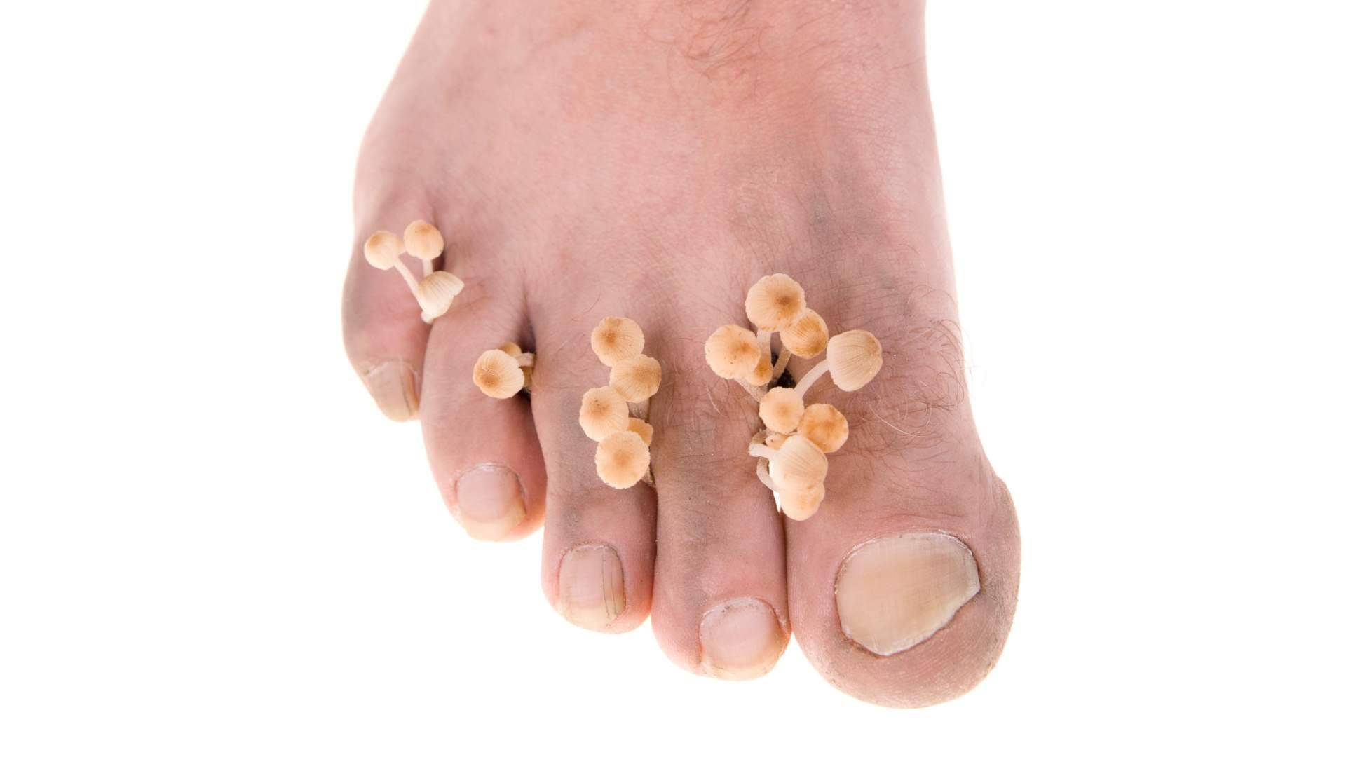 El verano multiplica los riesgos de sufrir micosis según los expertos de Laboratoires Bailleul