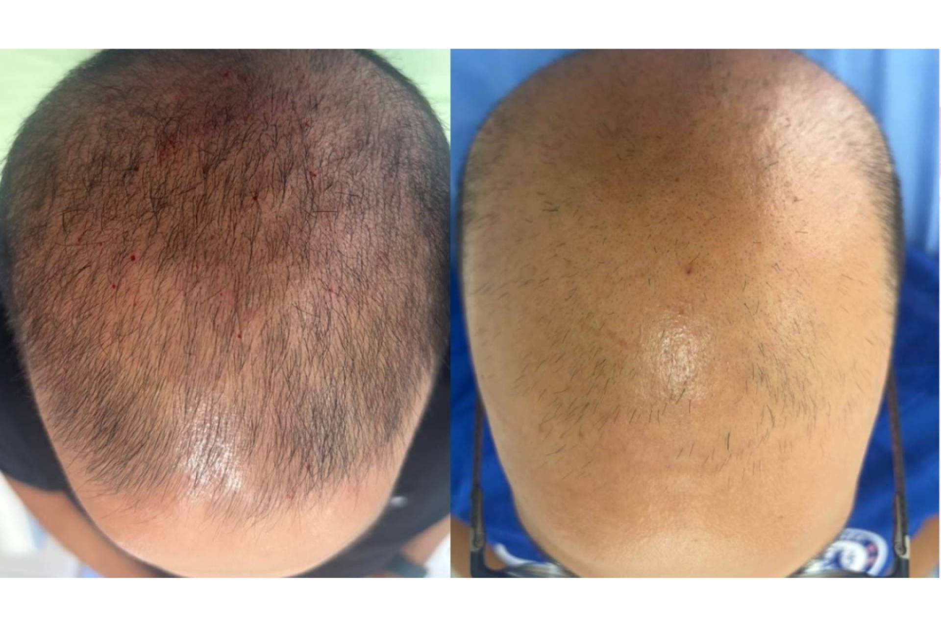 Alopecia androgenética y caída de cabello, qué esperar de los tratamientos en 2027