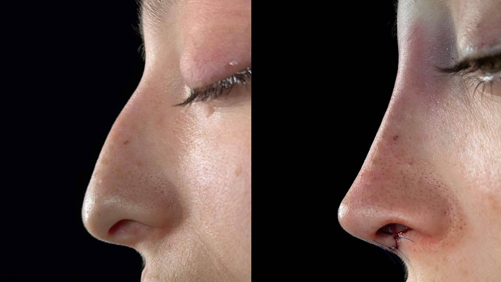 El Dr. Alfonso Campos sitúa la identidad facial en el centro de la planificación de la rinoplastia