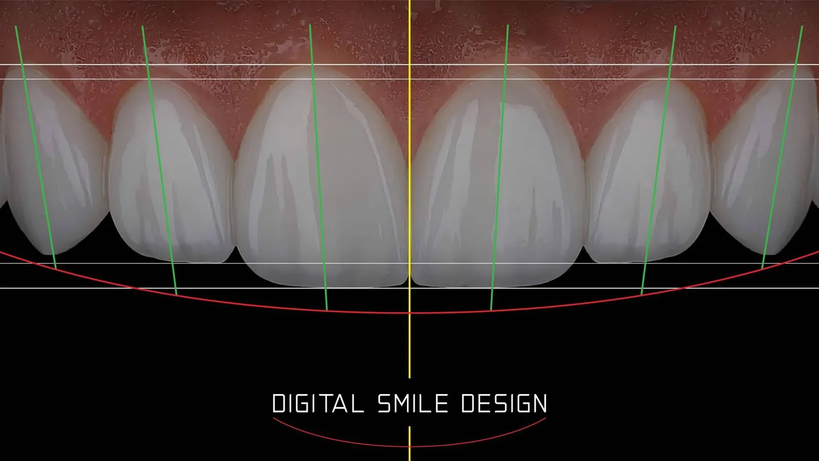 El Instituto Smile Design by Fernando Soria simplifica la estética dental en Madrid gracias al diseño digital de carillas en un día
